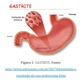 Gastrite-Química ⚗