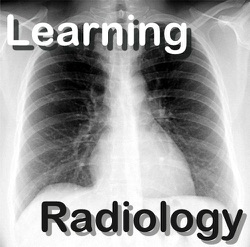 Video Podcast 55-Pulmonary Sarcoid-Radiographic Manifestations