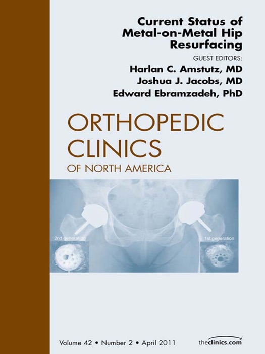 Current Status of Metal-on-Metal Hip Resurfacing, An Issue of Orthopedic Clinics - E-Book