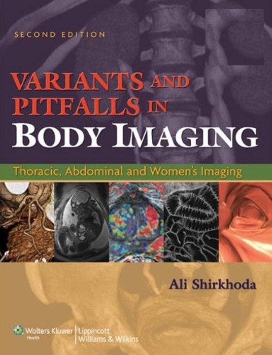 Variants and Pitfalls in Body Imaging: Second Edition
