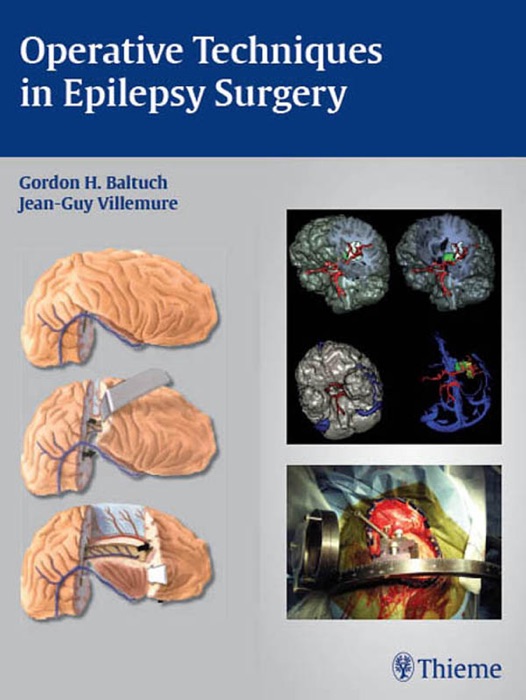 Operative Techniques in Epilepsy Surgery