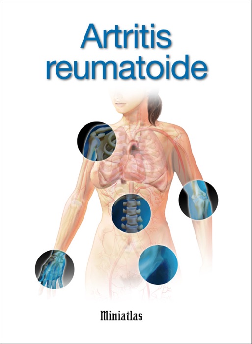 Miniatlas: Artritis reumatoidea