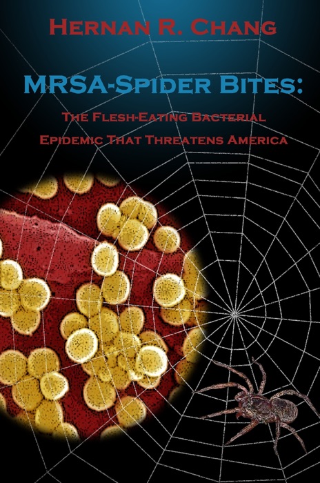 MRSA-Spider Bites: