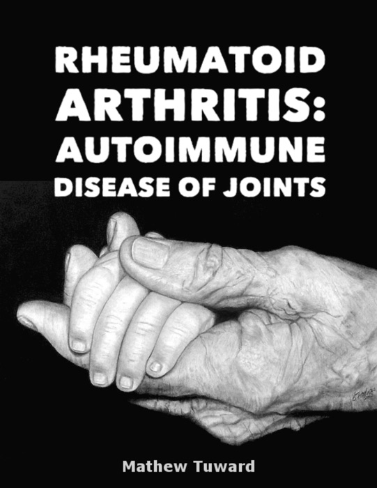 Rheumatoid Arthritis: Autoimmune Disease of Joints