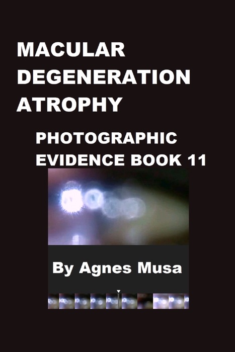 Macular Degeneration Atrophy, Photographic Evidence Book 11