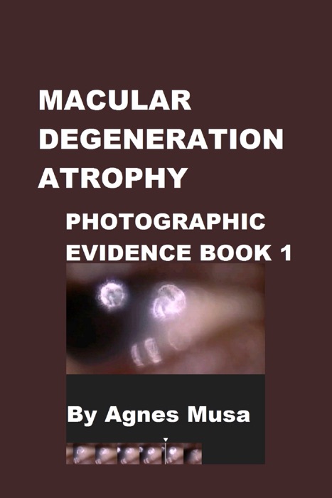 Macular Degeneration Atrophy, Photographic Evidence Book 1