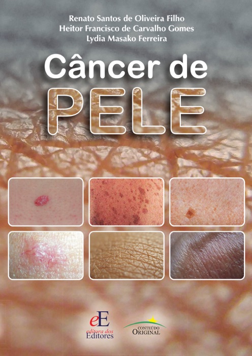 Câncer de pele