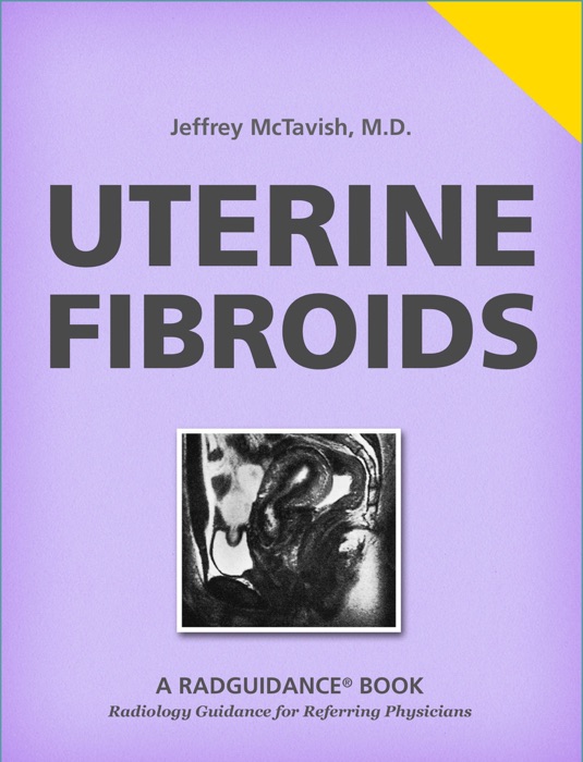 Uterine Fibroids