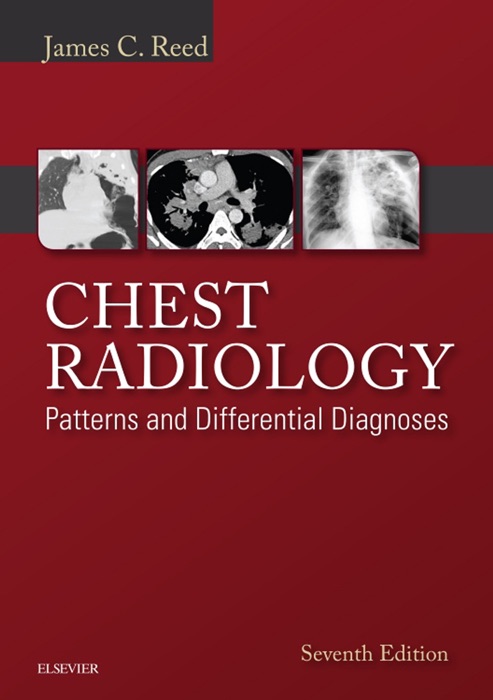 Chest Radiology: Patterns and Differential Diagnoses E-Book