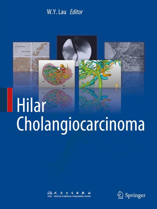 Hilar Cholangiocarcinoma