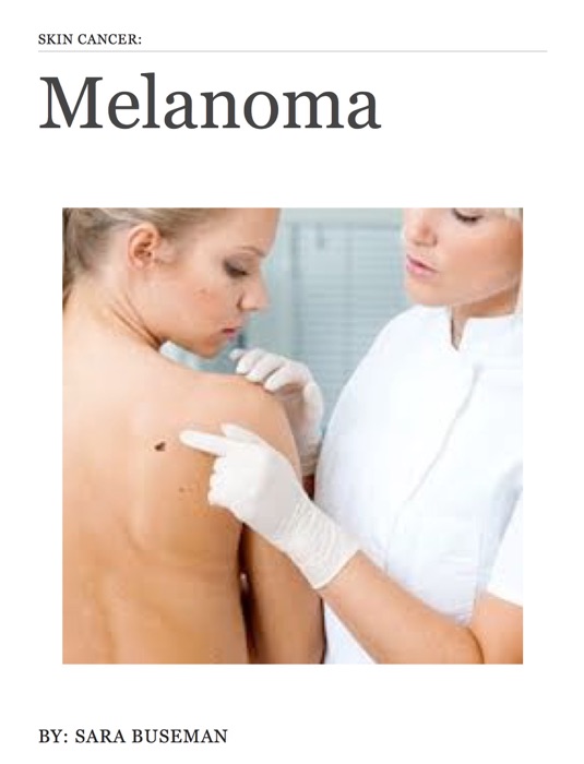 Skin Cancer: Melanoma