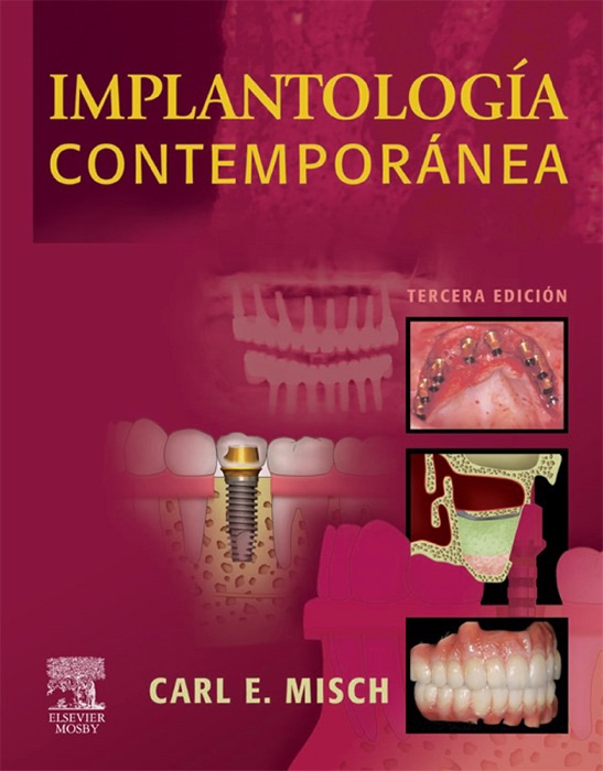 Implantología contemporánea