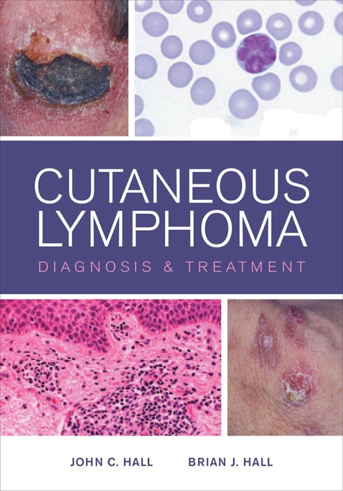 Cutaneous Lymphoma Diagnosis and Treatment