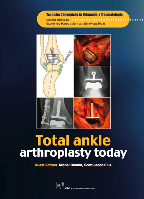 Total ankle arthroplasty today