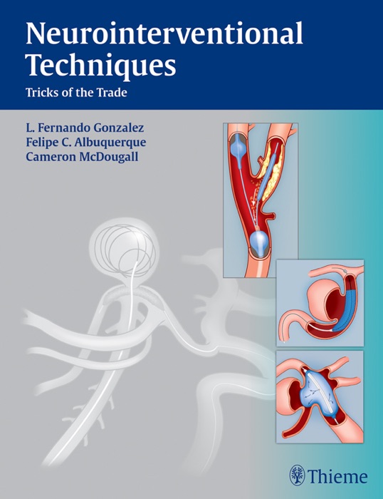 Neurointerventional Techniques