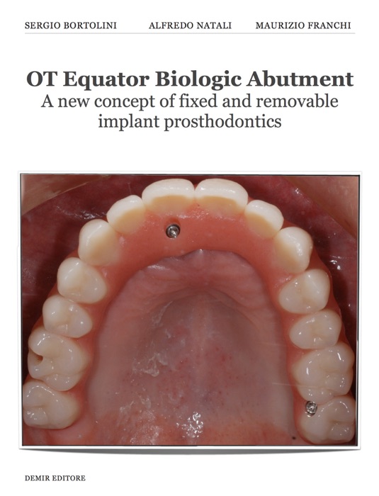 OT Equator Biologic Abutment A new concept of fixed and removable implant prosthodontics