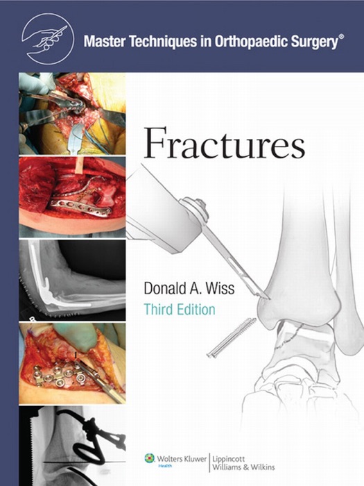 Fractures: Third Edition