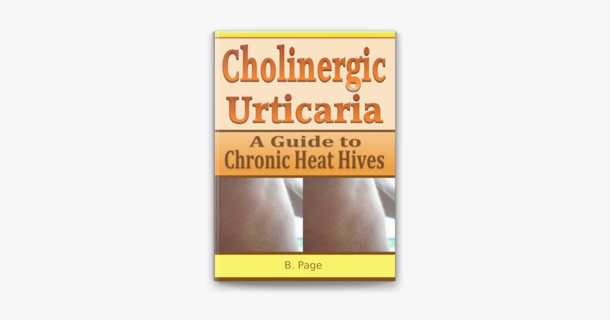 cholinergic-urticaria-a-guide-to-chronic-heat-hives-sur-apple-books