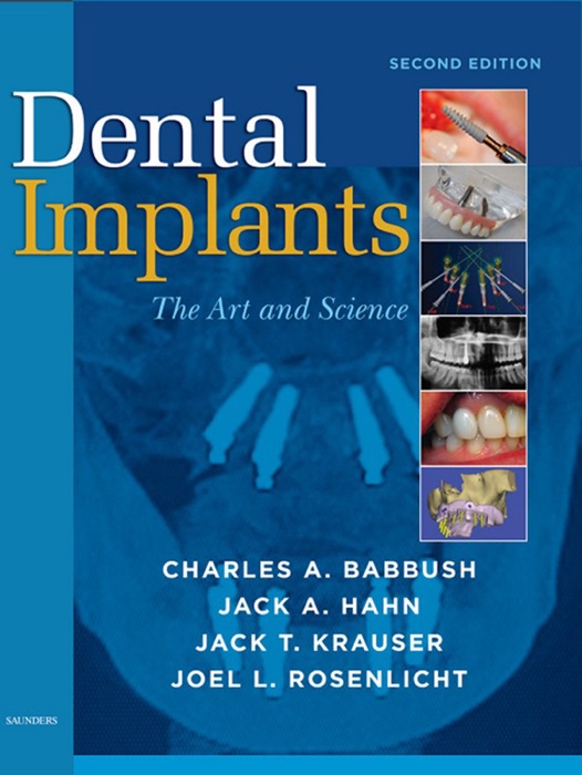 Dental Implants - E-Book