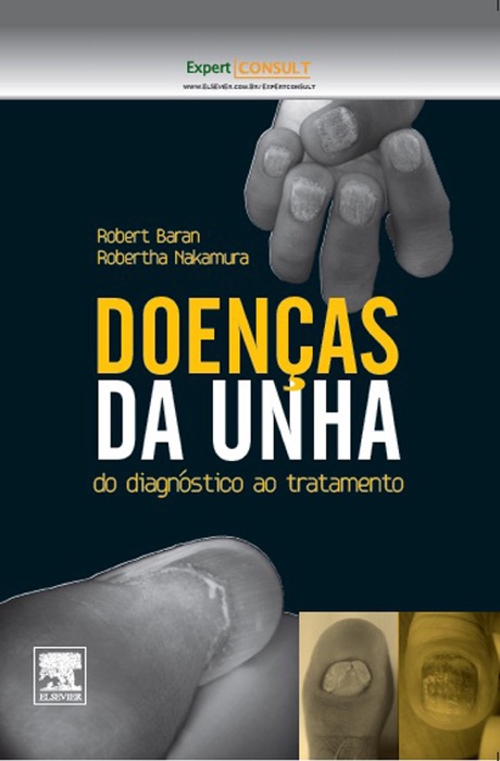 Deonças da unha: Do diagnóstico ao tratamento