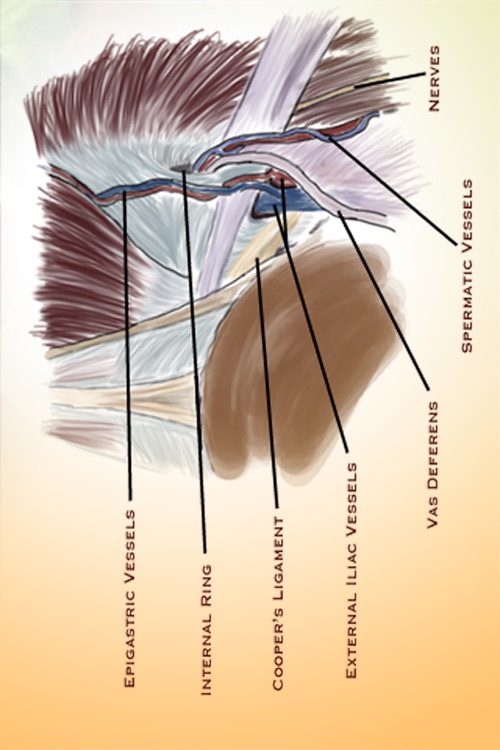 Laparoscopic Inguinal Hernia Repair