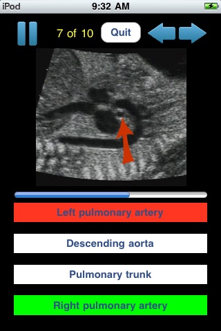 Sono Quiz Fetal Echocardiography Anatomy screenshot 2