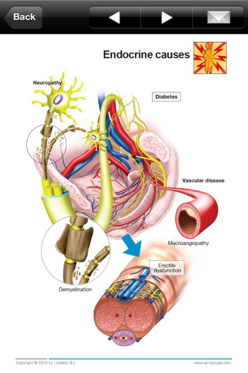 Miniatlas Erectile Dysfunction