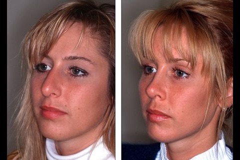 Facial Plastic Surgery: Before and Afters