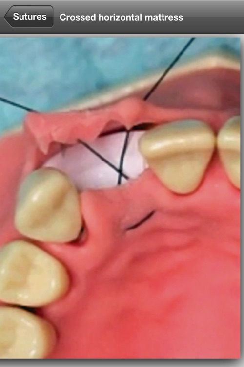 Suturing techniques Videos