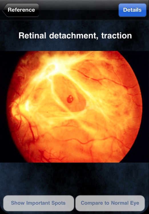 iEye Retina
