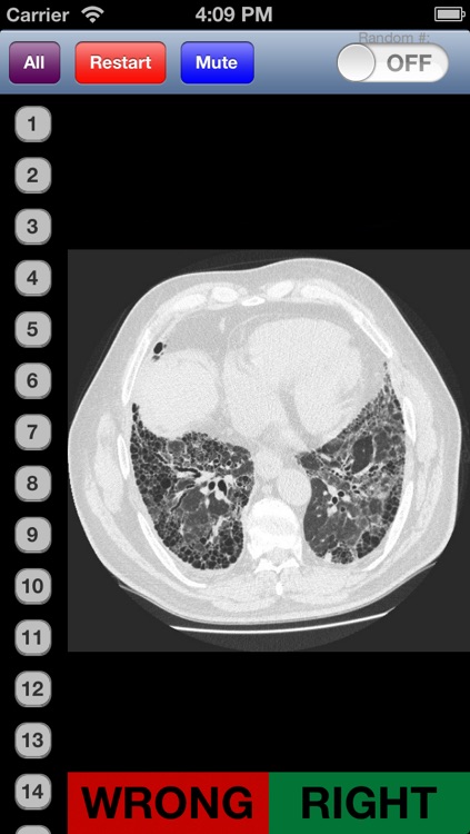 Chest Radiology Flashcards