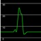 Learn to interpret Right Heart Catheter (Swan) waveforms with this hands-on approach