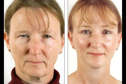 Facial Plastic Surgery: Before and Afters