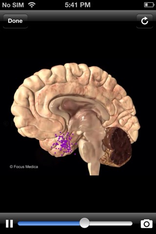 Animated Atlas of Diabetes screenshot 4