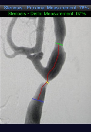 Angiosuite Stenosis Edition(圖2)-速報App