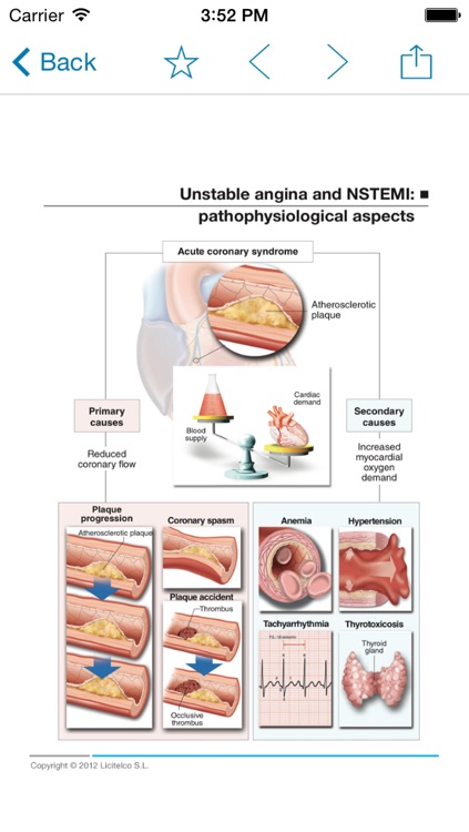 Miniatlas Acute Coronary Syndrome