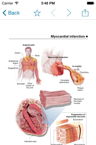 Miniatlas Acute Coronary Syndrome screenshot 3