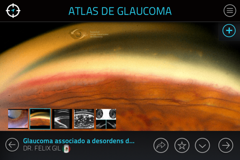 Atlas de Glaucoma para iPhone screenshot 4