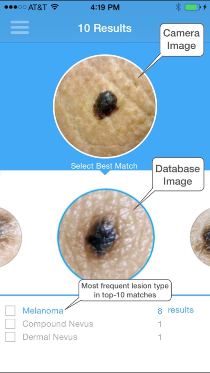 Lubax - Skin lesion ID using image recognition