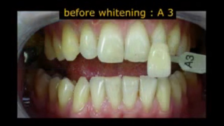 Teeth Whitening Techniques screenshot-4