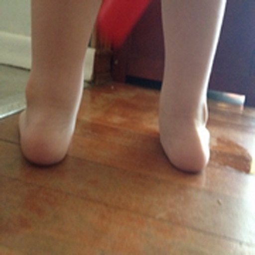 Symptoms Of Fallen Arches
