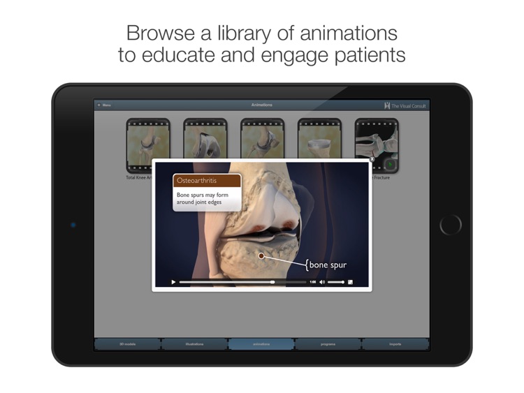 The Visual Consult: Knee Replacement screenshot-3