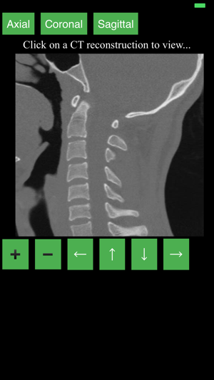 CT Cervical Spine(圖2)-速報App