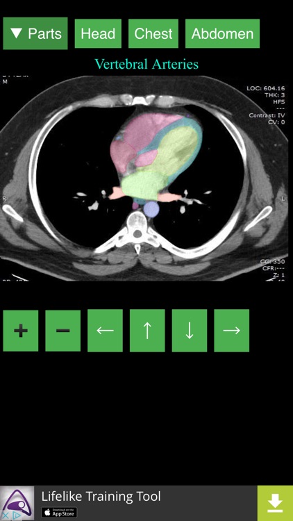 Anatomy on Radiology CT screenshot-3