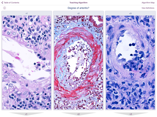 Renal Transplant Pathology(圖7)-速報App