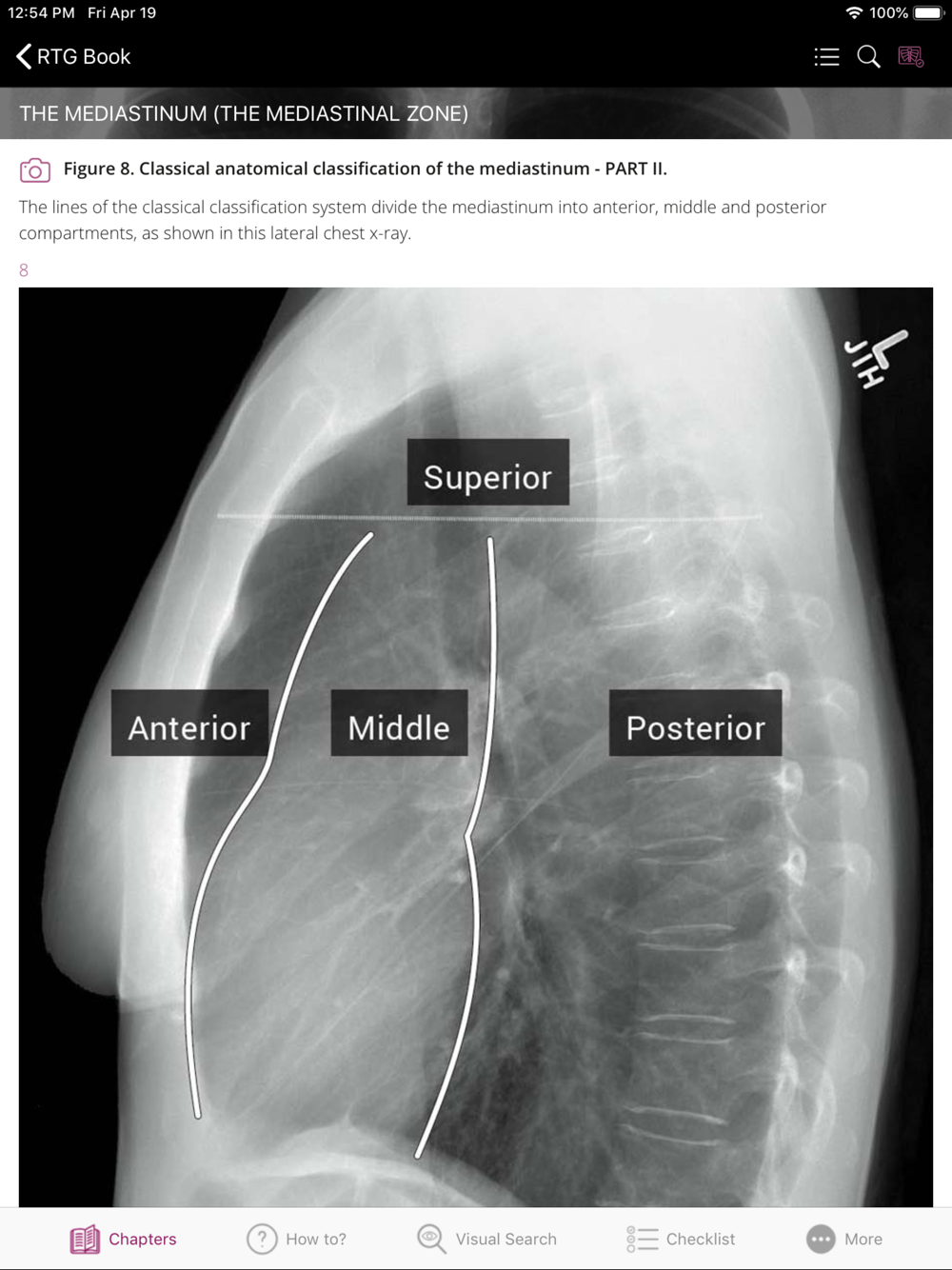 Chest X-ray Interpretation Free Download App for iPhone - STEPrimo.com