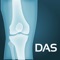 DAS, or "Disease Activity Score," is a measure of the activity of rheumatoid arthritis