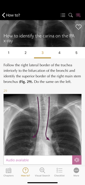 Chest X-ray Interpretation(圖4)-速報App