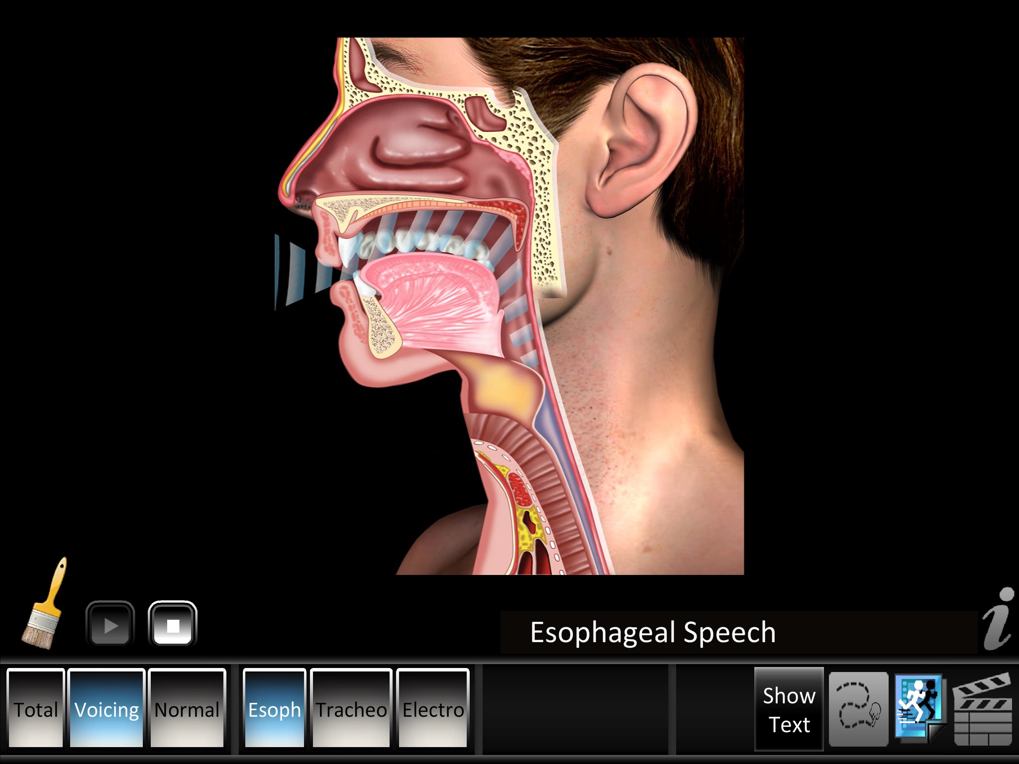 Laryngectomy screenshot 2