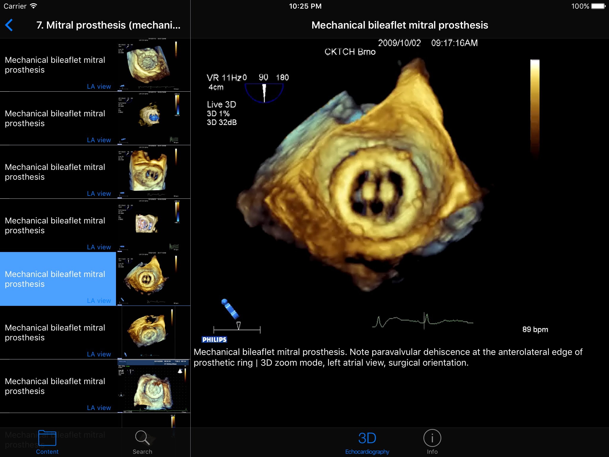 CARDIO3®3D Echocardiography HD screenshot 3